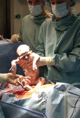 Césarienne : un risque accru de maladies infectieuses pour l’enfant