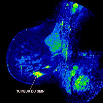 Campagne de sensibilisation contre le cancer du sein : Un dépistage de masse est-il possible ?