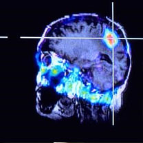 Dépistage précoce des tumeurs du cerveau grâce aux nouvelles techniques
