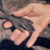 Malnutrition de l’enfant