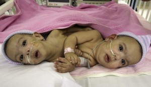 Mila : deux siamoises attendent une prise en charge depuis 30 mois !