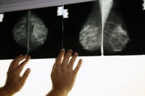 Cancers du sein : Découverte d’un marqueur de risque de métastases pulmonaires
