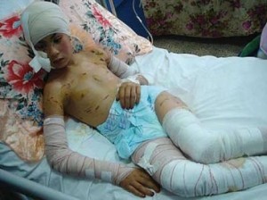 Un chien sème la terreur près de Bejaia, un enfant de 3 ans complètement défiguré