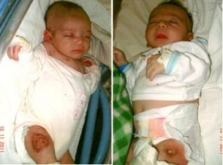 Des bébés risquent l’amputation à cause d’un vaccin suspect