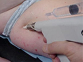 La Mésothérapie ,Une médecine esthétique tout en douceur