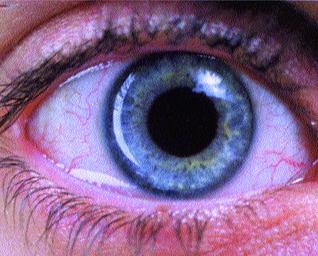 400.000 personnes atteintes de glaucome en Algérie