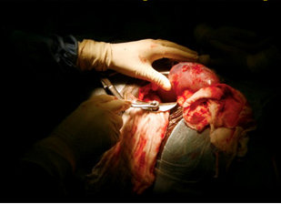 Admise pour une ablation de la vésicule biliaire dans une clinique privée à Oran,Une femme se fait voler un rein et décède à l’hôpital