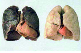 Cancer du sein et du poumon,Le dépistage en débat