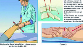 Traumatisme du genou,Fractures de la rotule