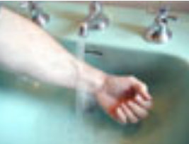 11 choses à savoir en cas de brûlure