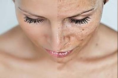 Je traite mes taches brunes