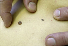 Mélanome,L’un des cancers les plus fréquents chez les jeunes