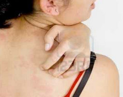 Offre d’emploi :  Boutons, démangeaisons… Et si c’était une allergie au soleil ?