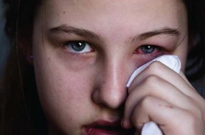 Plus de 8.000 cas de conjonctivite enregistrés à Oran