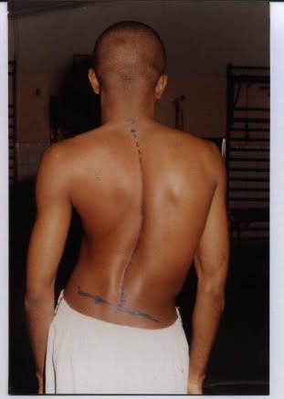 Blida, 300 malades de la scoliose sans prise en charge