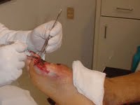 Séminaire national sur l’ulcère du pied diabétique, Vers la production d’Heberprot-P localement