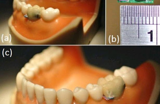 Une puce dans la bouche pour mesurer votre hygiène de vie