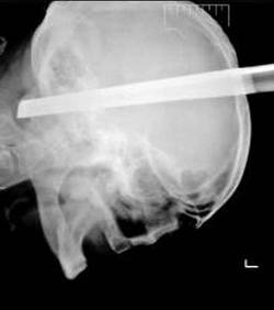 Après une bagarre, ce Serbe se retrouve avec 11 cm de métal fichés dans la tête