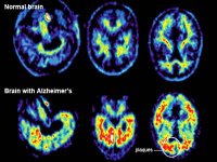 La préservation de l’activité de la mémoire prémunit contre la maladie d’Alzheimer