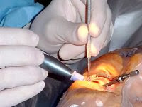 L’arrêt de l’importation de greffons à l’origine du recul de la greffe de la cornée en Algérie