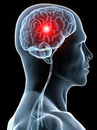 Les accidents vasculaires cérébraux : 50 000 nouveaux cas recensés annuellement