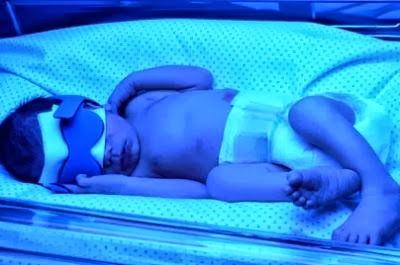 L’ictère du nouveau-né (« bousfaier»)