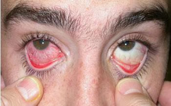 Les ravages du Glaucome en Algérie, 100.000 cas traités chaque année