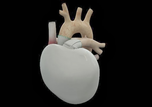Première implantation d&rsquo;un cœur artificiel total