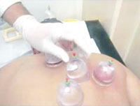 Hépatites B et C, La hidjama, facteur de risque