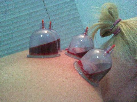 La hijama : qu’est-ce que c’est ?