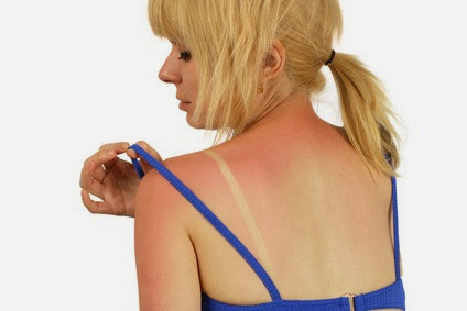 Le danger du soleil ne vient pas uniquement des coups de soleil