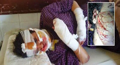 MAROC : Il lui défigure le visage pour que personne ne se marie avec elle