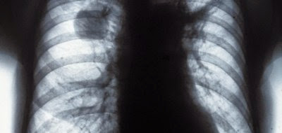 Cancer du poumon: une moyenne de 3500 nouveaux cas/an en Algérie (spécialistes)
