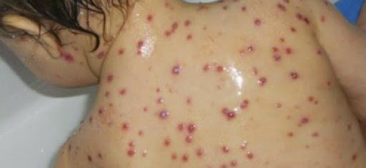 La rougeole peut affaiblir le système immunitaire