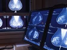 Une nouvelle thérapie ciblée confirme son efficacité contre le cancer du sein