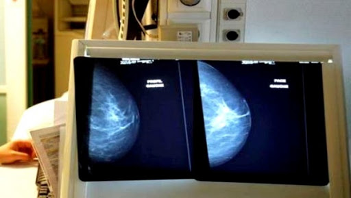Les polycliniques seront progressivement équipées de mammographes (ministre)