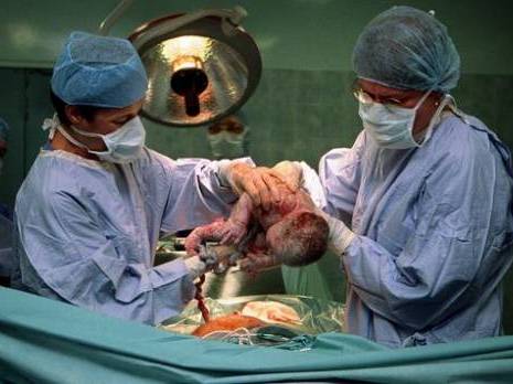 Près de 24 % des accouchements en Algérie sont réalisés par césarienne