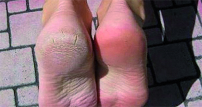 Talons crevassés : une astuce incroyable pour les combattre