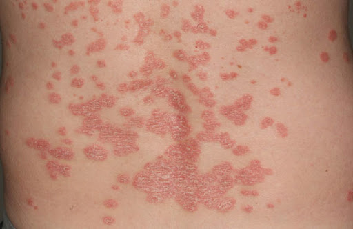 Psoriasis : Une maladie héréditaire, à évolution chronique