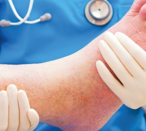 ULCÈRE DIABÉTIQUE: Une nouvelle combinaison enzymatique accélère la cicatrisation