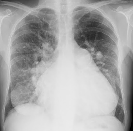 1er congrès de la société Algérienne de l’hypertension pulmonaire (SAHP): Plaidoyer pour une « prise en charge pluridisciplinaire »