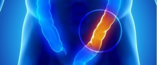 Le cancer du rectum et du colon en progression d&rsquo;année en année en Algérie