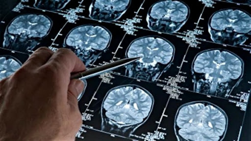 Les commotions cérébrales ne conduisent pas forcément à une dégénérescence neurologique