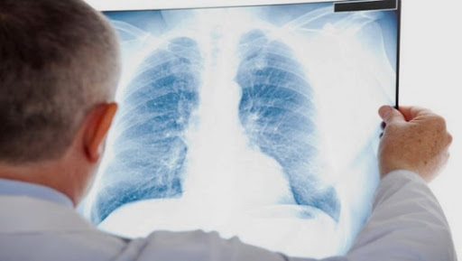 La tuberculose extra-pulmonaire en hausse en Algérie