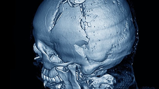 Traumatismes crâniens : la société algérienne d&rsquo;anesthésie-réanimation tire la sonnette d&rsquo;alarme