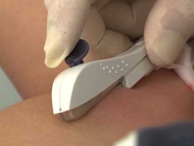 Congrès de gynécologie obstétrique L’implant, un nouveau moyen contraceptif