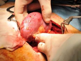 Greffe rénale : de l’insuffisance de donateurs et de l’insuffisance de moyens