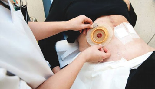 Tizi-Ouzou : Les patients stomisés dans la tourmente