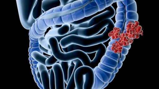 Cancer colorectal: lancement du dépistage précoce à Bejaia