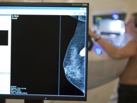 Découverte de la presque totalité des anomalies génétiques à l&rsquo;origine des cancers du sein